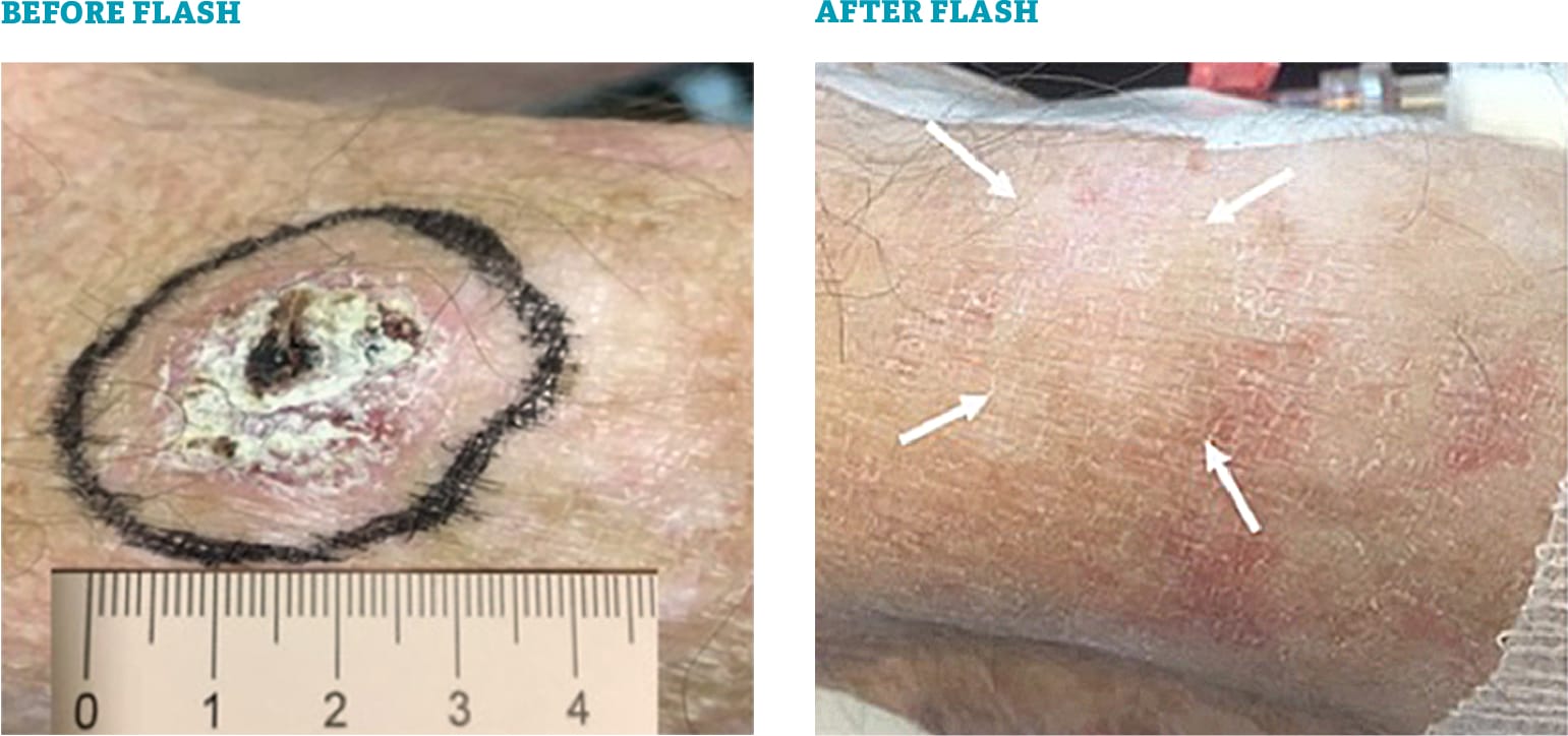 Before and After treatment photos using electron high-dose rate FLASH radiotherapy (FLASH RT)